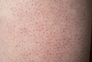 Skintech Easy Phytic peel