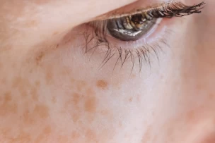 Skintech BeneBellum Lumpeel TCA kombinált hámlasztás