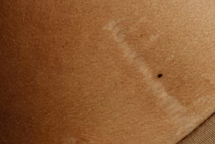 hegek kezelése, műtét utáni heg