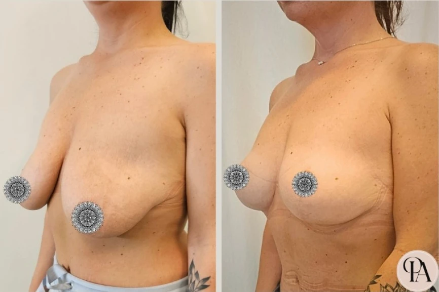 Mellfelvarrás - Dr. Párkányi Adrienn plasztikai sebész munkája