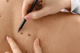 anyajegyszűrés, rákszűrés, bőrgyógyászat