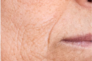 Dohányzó ráncok botox kezelése