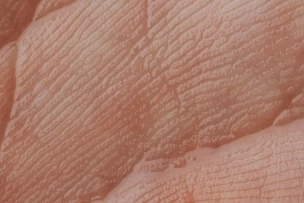 fokozott tenyér és talp láb izzadás