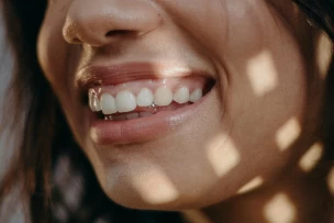 gummy smile, ínyes mosoly