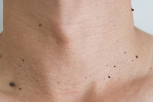 Jóindulatú bőrnövedékek eltávolítása