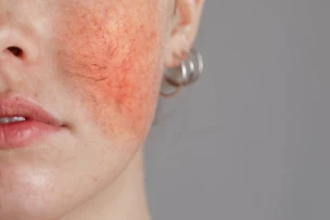 rozácea