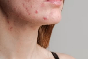 akne kezelése, pattanások, pattanásos bőr