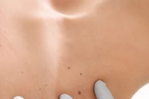 Anyajegy eltávolítás